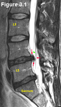 para-sagittal HNP